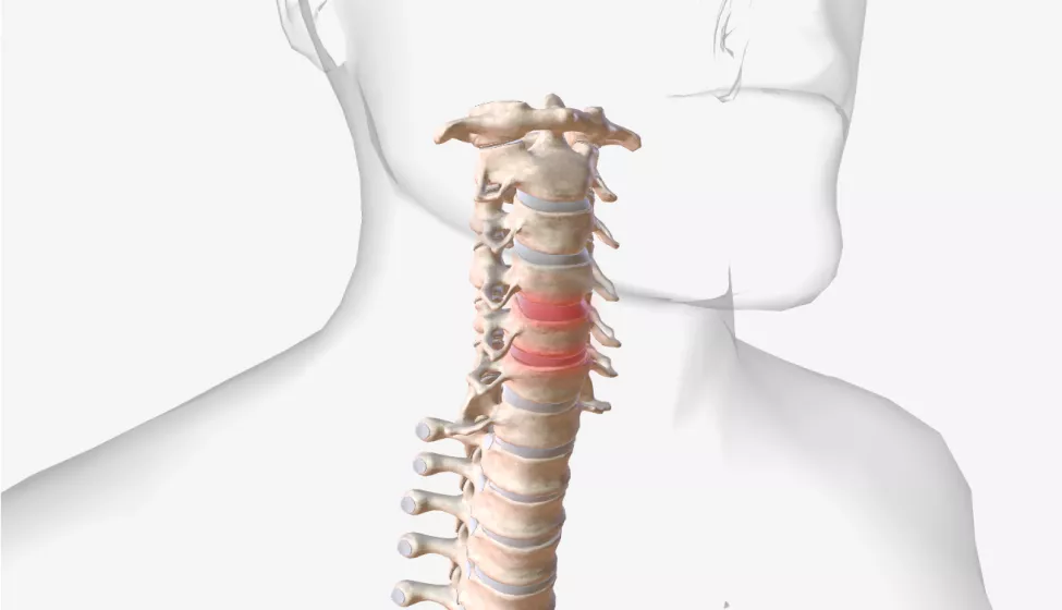 Cervical spine injury illustration