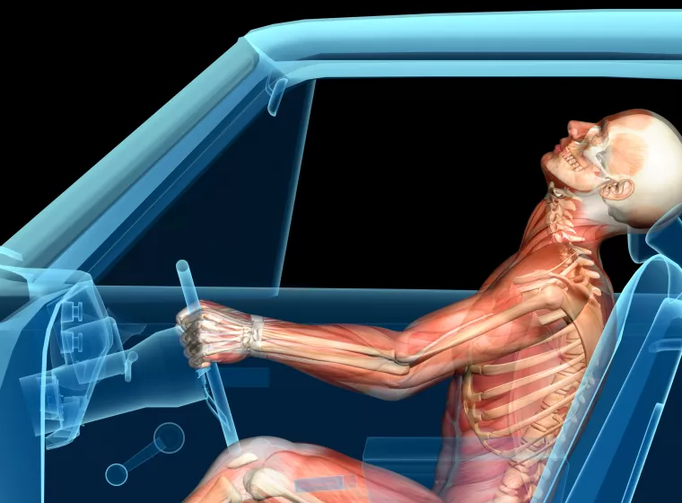 Muscular skeletal sketch of individual in car crash. Exponent biomechanical analysis of injury claims.