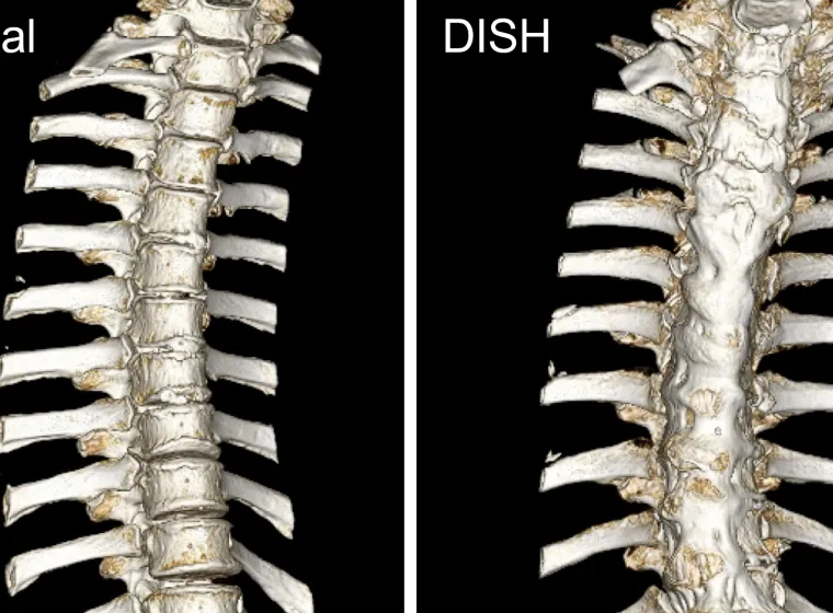 Spine Comparison